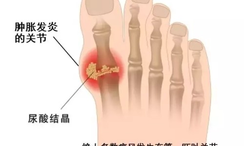痛风能吃葵花籽吗